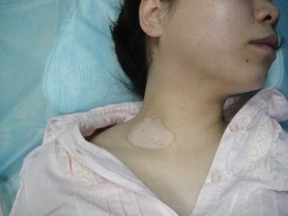 早期白癜风有哪些方面的外在症状